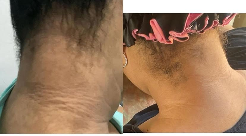 YIYU Original 100 Pads –  para una Piel Más limpia y Radiante