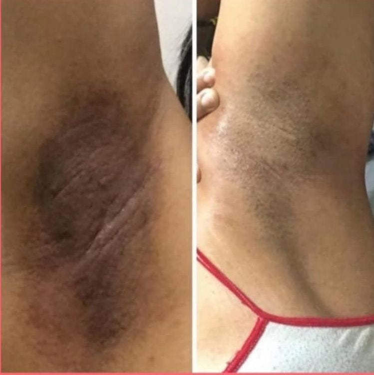 YIYU Original 100 Pads –  para una Piel Más limpia y Radiante
