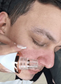 LIMPIADOR FACIAL/ LIMPIADOR DE ESPINILLAS Y PUNTOS NEGROS